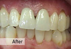 zirconia crown after Watercress Dental Clinic, Dentist in Alton Hampshire